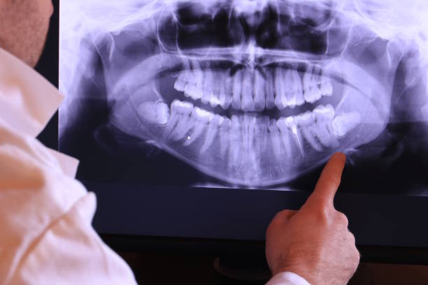 Best Emergency Root Canal Treatment in Livonia, LA